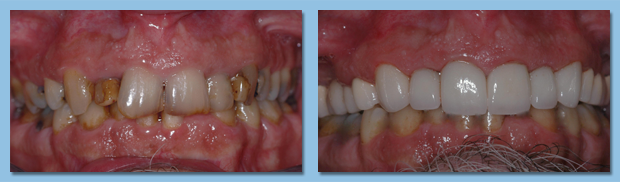 Patient with decayed teeth transformed his smile with dental implants from an Apollo Beach dentist.