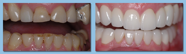 CEREC porcelain crowns and bridges helped this patient in Gibsonton.