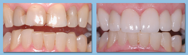 Patient's upper teeth are visibly improved thanks to the Apollo Beach dentists at Your Time Dental.