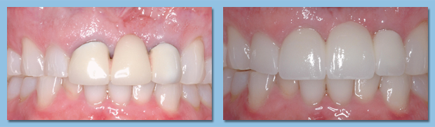 Dental implants used as a tooth replacement option for a patient from Apollo Beach.