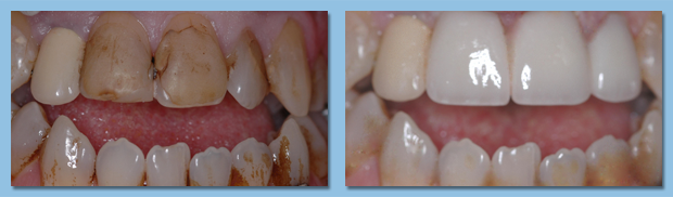 Patient showing before and after effects of tooth veneers on her smile.