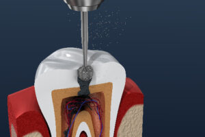 image of a root canal being performed, drilling into pulp to treat infection