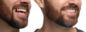 side by side of a bearded man, dental implant for missing tooth