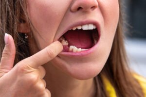 closeup of a woman who had a tooth extracted from her lower mouth