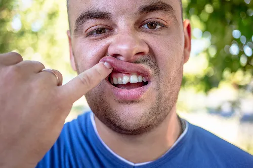 man in blue shirt exposing a chipped tooth