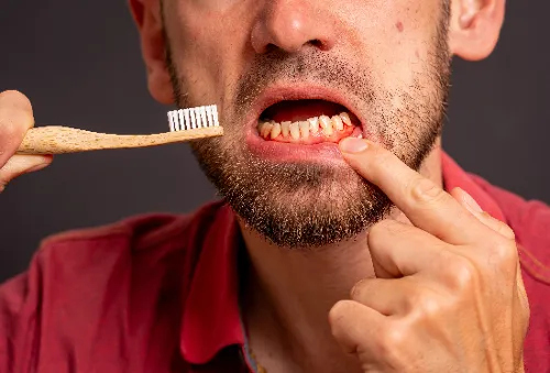 closeup of a man brushing his bloody gums, early gum disease