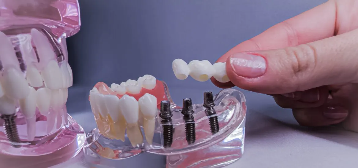 dental bridge model, unseen dentist