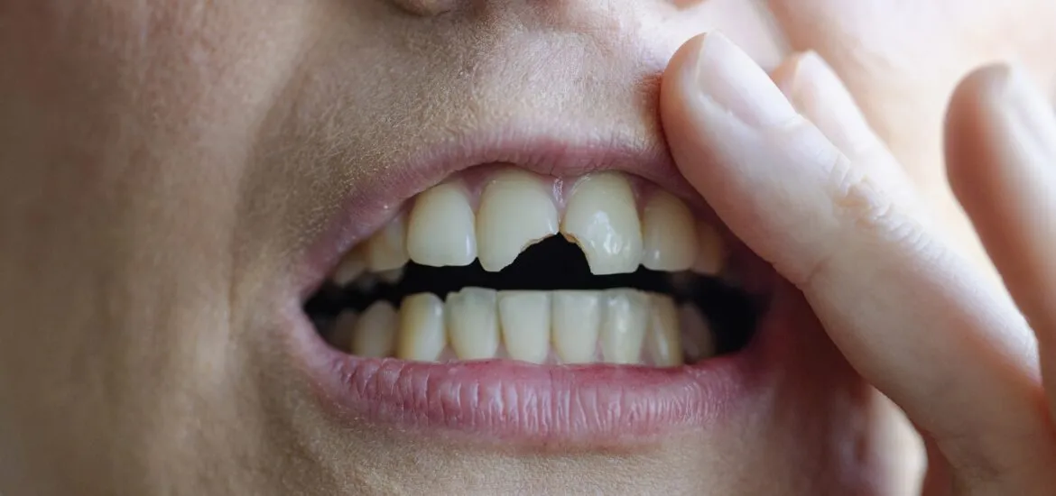 A person points to a chipped tooth while showing signs of oral health problems.